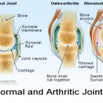 Reumatoidni artritis?